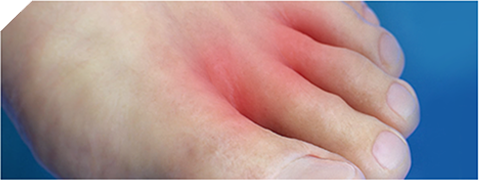 Лечение запущенного грибка кожи и ногтей